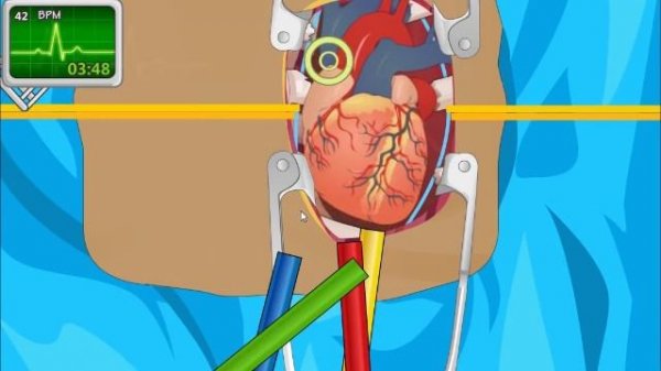 Operate Now: Heart Surgery - Walkthrough