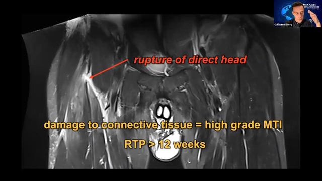 Focus on Sports Imaging - OCAD/SRad-RJ MSK Case Presentation Series смотреть онлайн