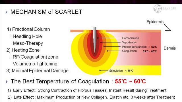 Fractional RF microneedle - Scarlet RF смотреть онлайн