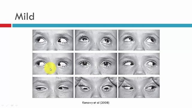 Brown's Syndrome Classification смотреть онлайн