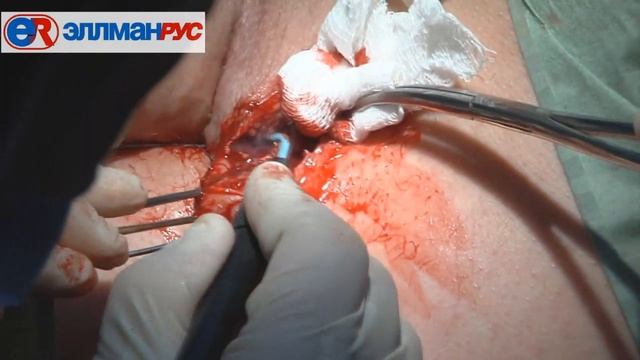 Свищ прямой кишки Мухин смотреть онлайн