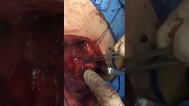 Left selective cervical lymph node dissection of levels 2,3,4,5, & 6... смотреть онлайн