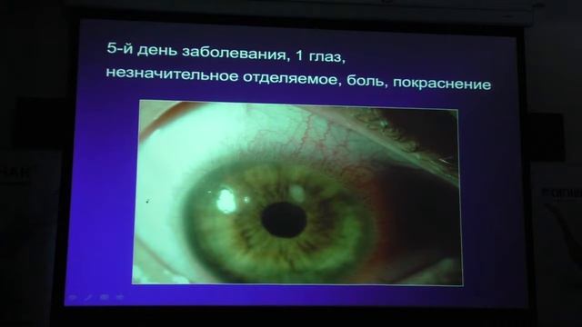 Бактериальные кератоконъюнктивиты