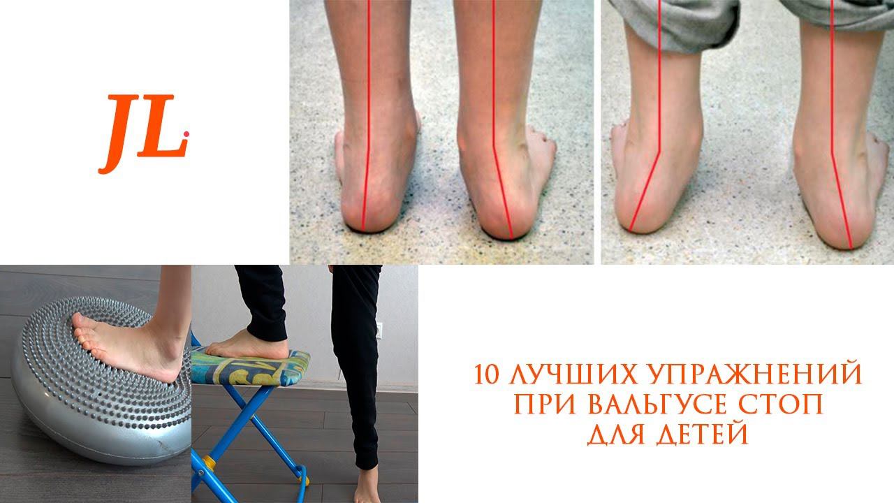 10 ЛУЧШИХ УПРАЖНЕНИЙ ПРИ ВАЛЬГУСЕ ДЛЯ ДЕТЕЙ смотреть онлайн