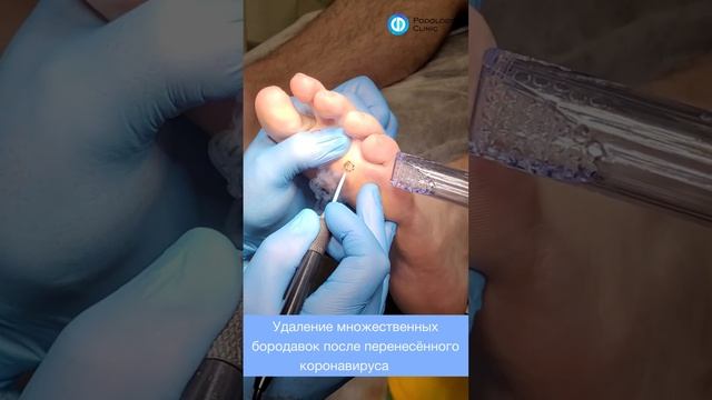 Удаление бородавок #удалениебородавок #бородавки #подологмосква #подология #клиникаподологии смотреть онлайн