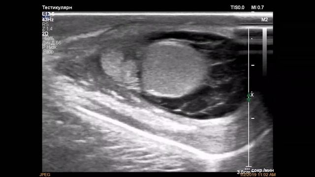 Двусторонний орхоэпидидимит младенца смотреть онлайн