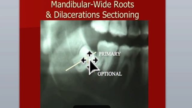 Oral Surgery Hints - Impactions Continued смотреть онлайн