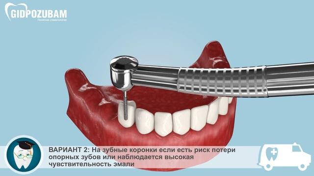 Бюгельные протезы. Этапы установки бюгельного протеза на кламмерах смотреть онлайн