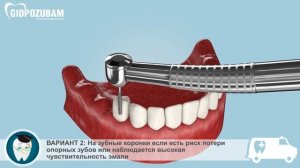 Бюгельные протезы. Этапы установки бюгельного протеза на кламмерах