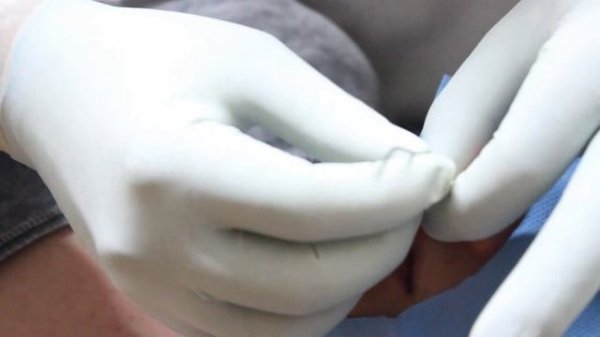 Medusa Piercing Aplicação - Philtrum Piercing