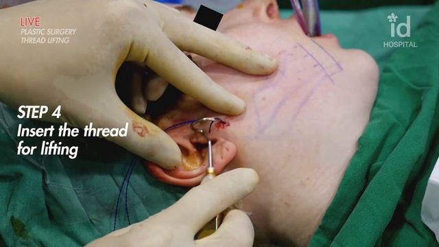 LIVE Plastic Surgery Video l THREAD LIFTING ? смотреть онлайн