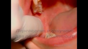 Мандибулярная анестезия.Cтандартная техника.