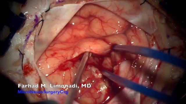 Brain Surgery And Removal Of Glioblastoma Multiforme (GBM Malignant Brain Tumor)