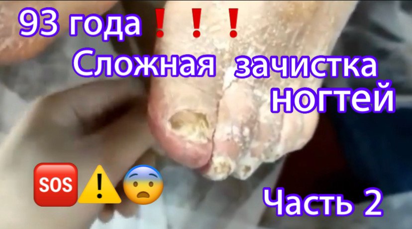 93 года ❗️❗️❗️ Сложная зачистка ногтей⚠️???• Часть 2 смотреть онлайн