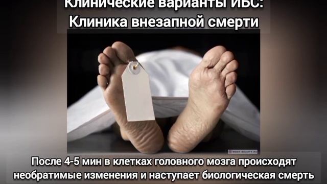 Ишемическая болезнь сердца (ИБС) смотреть онлайн