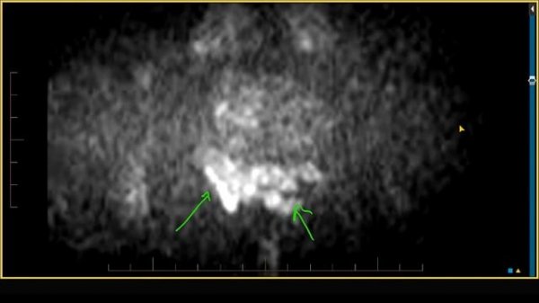 PI RADS 5 Case Review on MRI