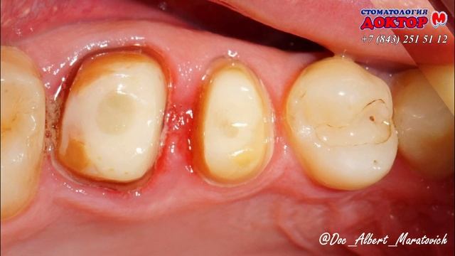 Что лучше - пломба или коронка? Из чего делается пломба или коронка? Замена пломбы на коронку. смотреть онлайн