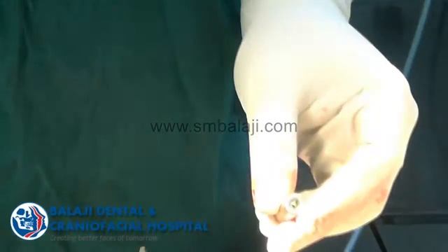 Sinus Lift with Immediate Implant Placement and Bone Grafting смотреть онлайн