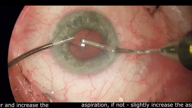Обучение факоэмульсификации. Часть 2. Training For A Phacoemulsification. Part 2