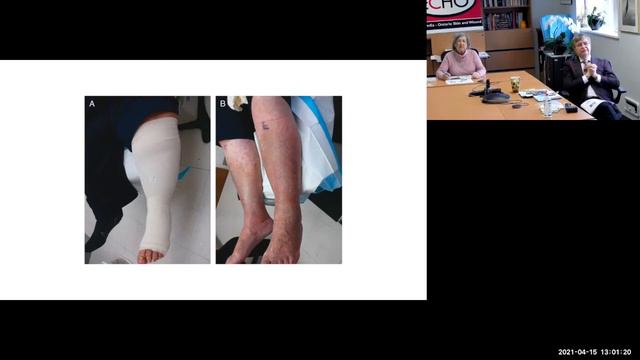 Low wound compression webinar with Dr Sibbald & Pat Coutts смотреть онлайн