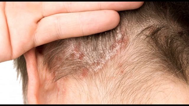 Себорейный дерматит как избавиться за неделю! смотреть онлайн