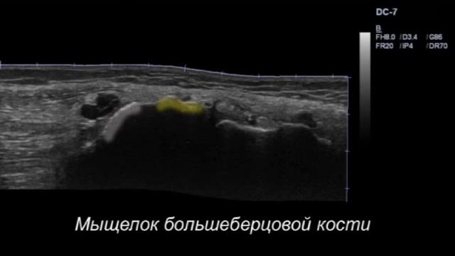 Гигрома коленного сустава