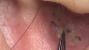 Выдавливание чёрных точек.