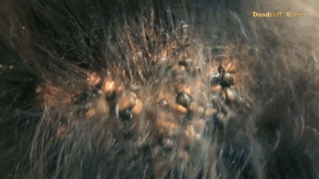 Hair Clinic Remove Hundreds Of Lice From Client's Head # 194 смотреть онлайн