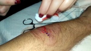 Зашивание  раны от циркулярной пилы в домашних условиях/Sewing a wound from a circular saw at home
