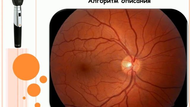 Алгоритм описания глазного дна смотреть онлайн