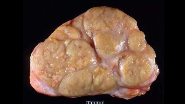 Gross Path of Lymph Nodes Part 3 - Neoplasia смотреть онлайн