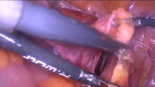 Total laparoscopic hysterectomy with sentinel lymph node biopsy in endometrial carcinoma. смотреть онлайн