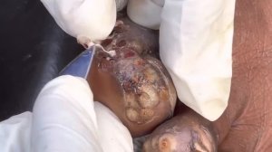 John Nabuule's last jigger digging two videos published @https://riseupsociety.net