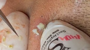 Relax Every Day (Blackheads on the neck) #SacDepSpa483