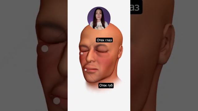 Анафилактический шок смотреть онлайн