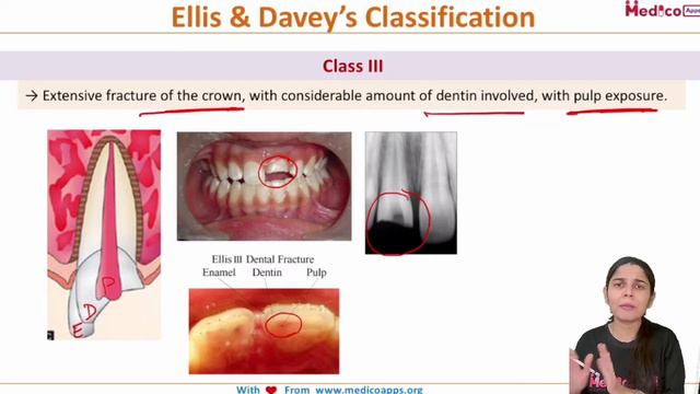 Ellis and Davey classification [MCQ Discussion - Updated Video] смотреть онлайн