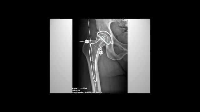 Preoperative Planning - Juan C Suarez, MD смотреть онлайн