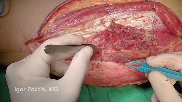 MICROSURGERY - Chimeric ALT Musculo-Cutaneous Flap Harvest смотреть онлайн