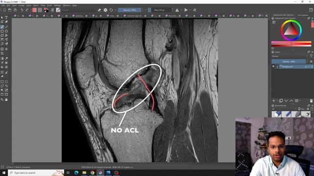 ACL Tear - How to see on MRI? Knee ligament tear | Knee instability - Dr Ramprasad Kancherla смотреть онлайн