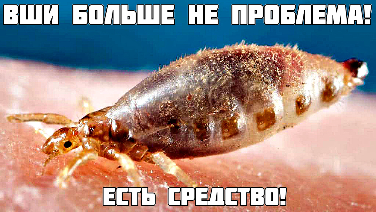 Это средство избавит от вшей за 1 применение! Как избавиться от вшей как бороться с вшами? смотреть онлайн