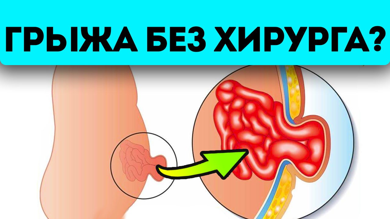 Лечение без операции возможно?! Вот как можно облегчить пупочную грыжу смотреть онлайн