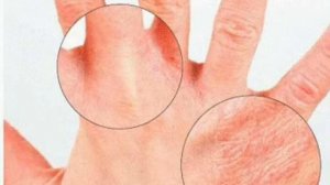 Экзема,дерматит,себорея псориаз!СЕРНАЯ МАЗЬ!