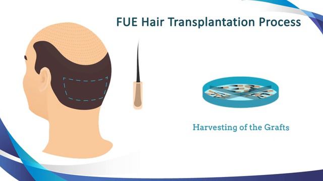 FUE Hair Transplantation Process Symbiosis Cosmetology Center смотреть онлайн