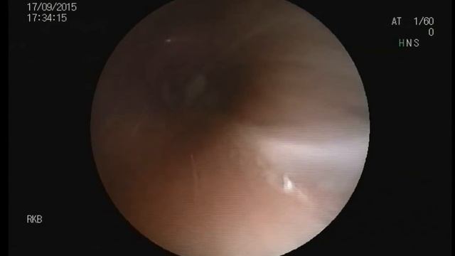 Эндоскопическое удаление инородного тела промежуточного бронха смотреть онлайн