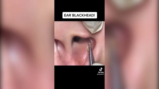 Popping huge blackheads and Pimple Popping - Best Pimple Popping Videos #23 смотреть онлайн