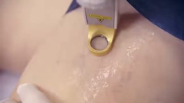 Cutera Excel V spider vein treatment смотреть онлайн