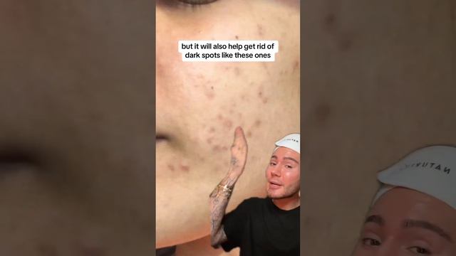 VIRAL ANTIAGING TIP!😱 (follow for more!💗) #antiaging #aging #wrinkles #beauty #skincare #skin смотреть онлайн