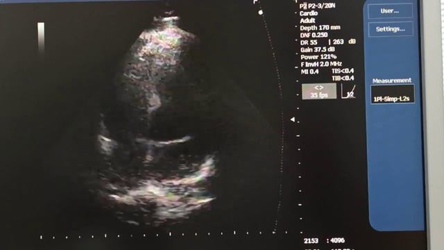 Какая локализация инфаркта миокарда вопрос смотреть онлайн