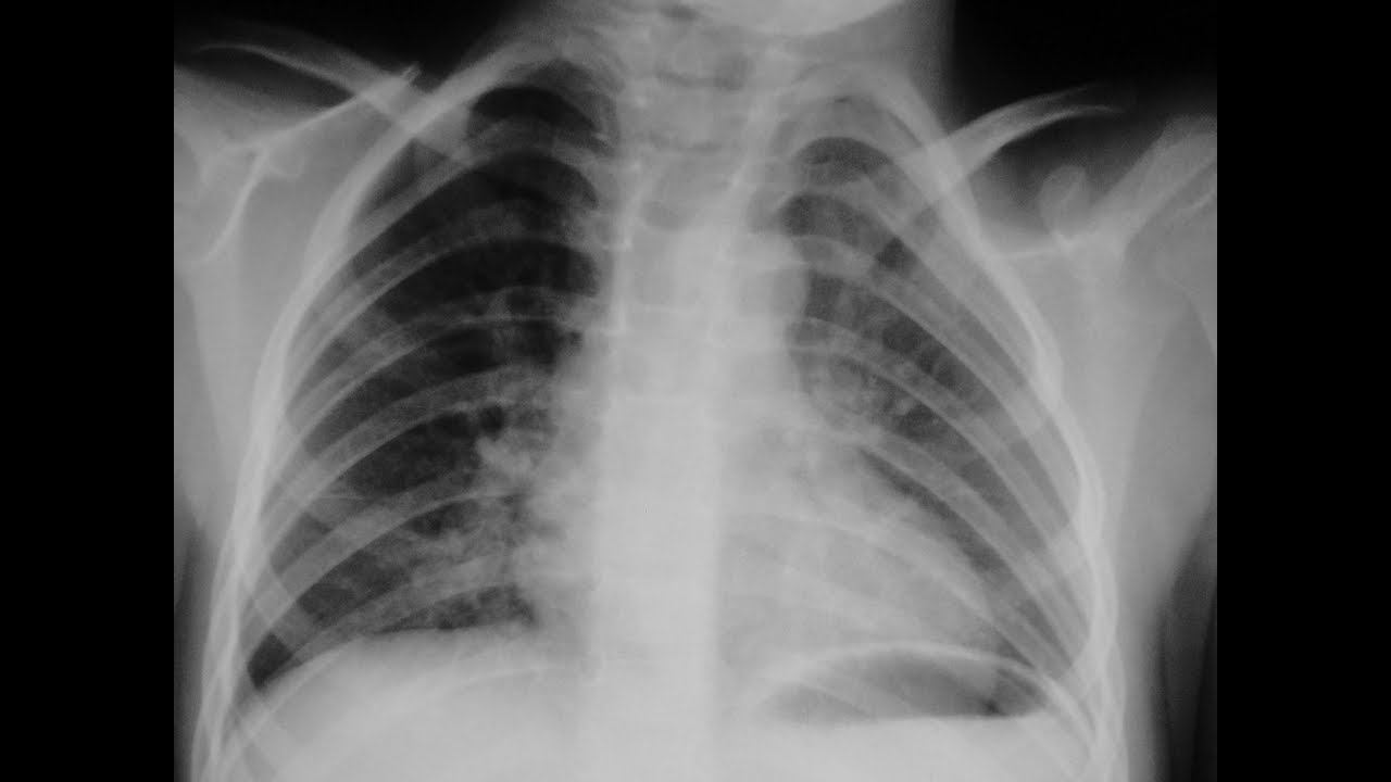 Пневмония и бронхит. В чем отличия? смотреть онлайн