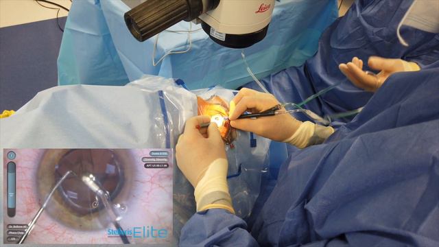 Impianto di lente IC8 in Live Surgery смотреть онлайн